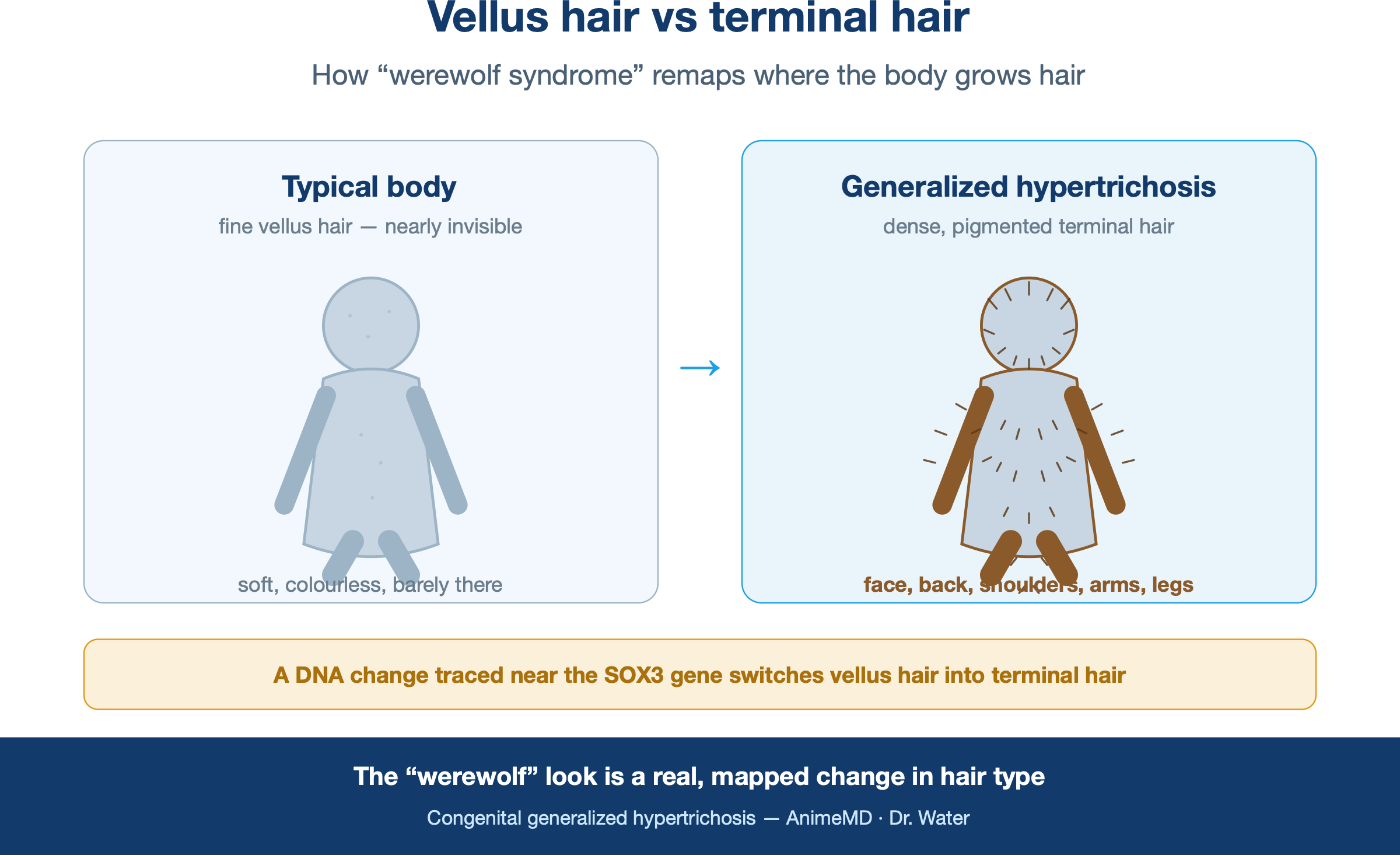 Vellus hair vs terminal hair — how “werewolf syndrome” remaps body hair